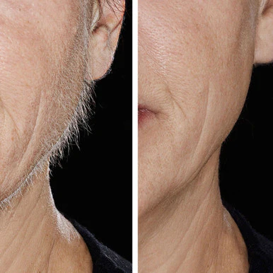 Hollywood Smoother, Sonic Dermaplaner- Rose Gold - Image 4