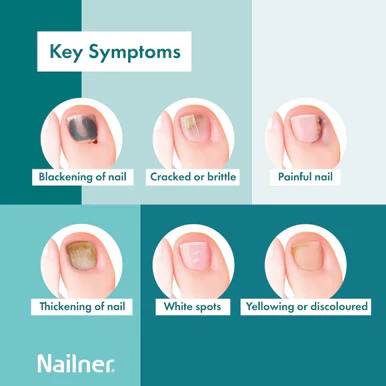 Nailner Active Cover - Nail Fungus Treatment 30ml - Image 3