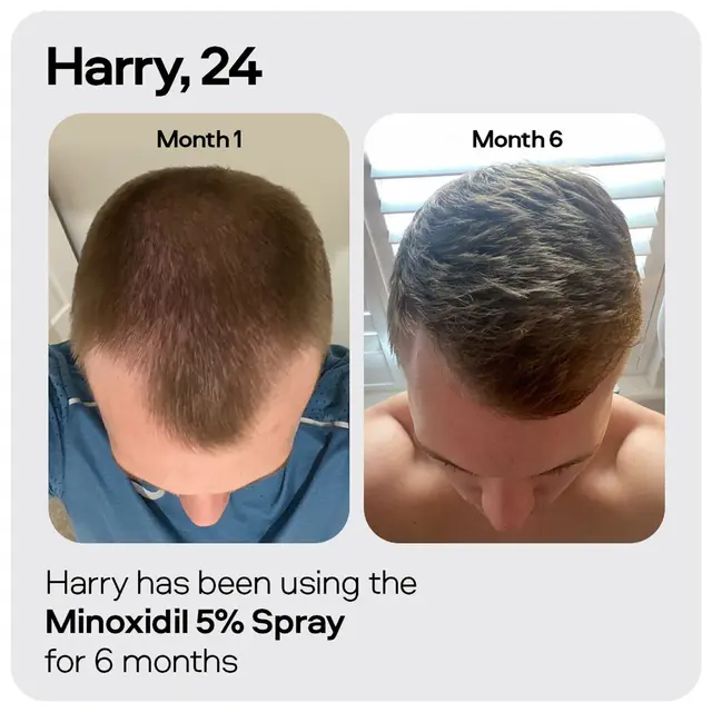 Sons Minoxidil 5% Spray 3 Pack x4 - Image 5